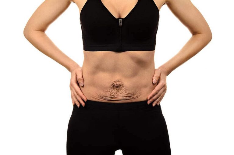 Diástase Abdominal